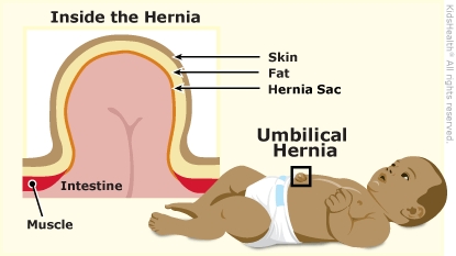 [Resim: herniaUmbilical_a_enIL.jpg]